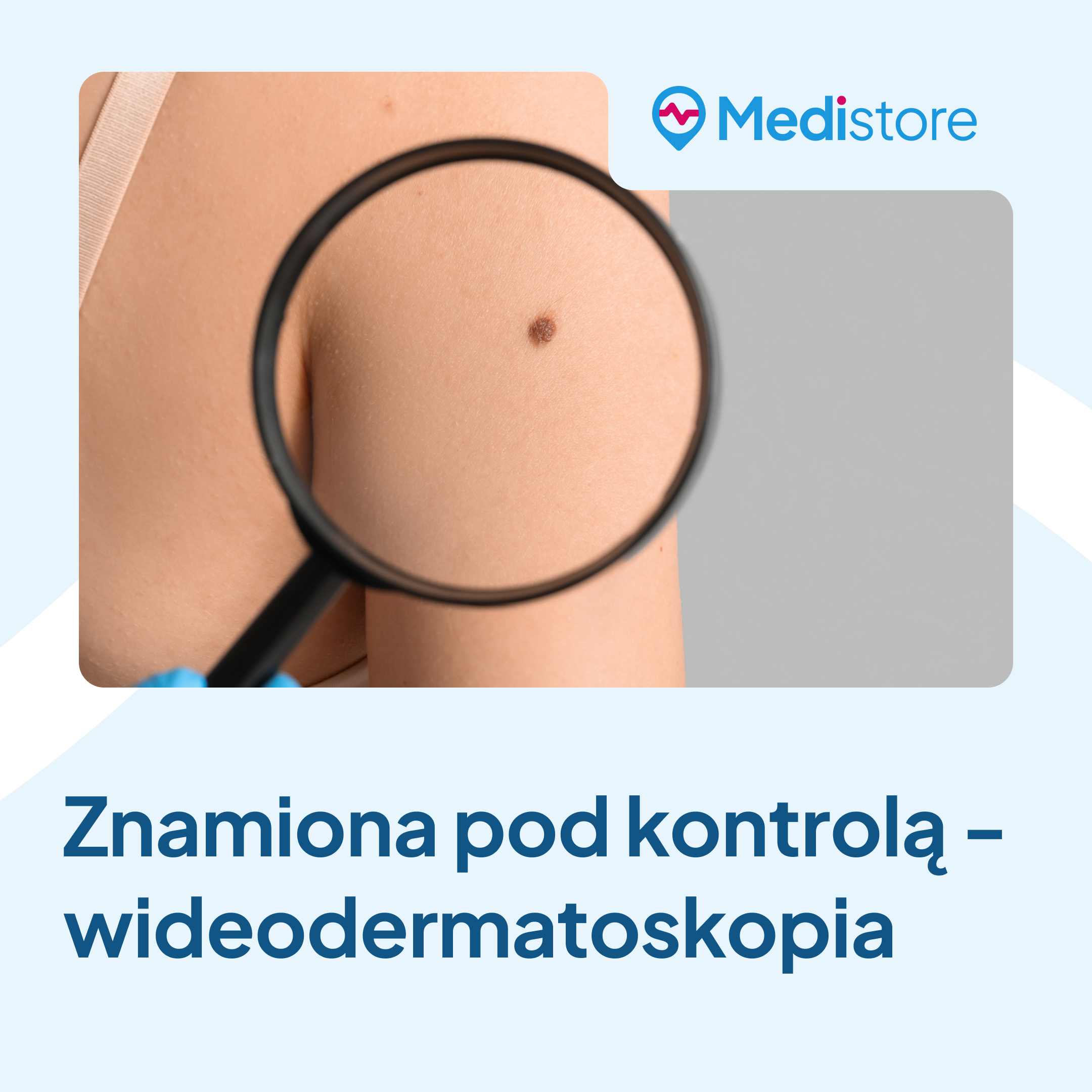 Znamiona pod kontrolą – wideodermatoskopia