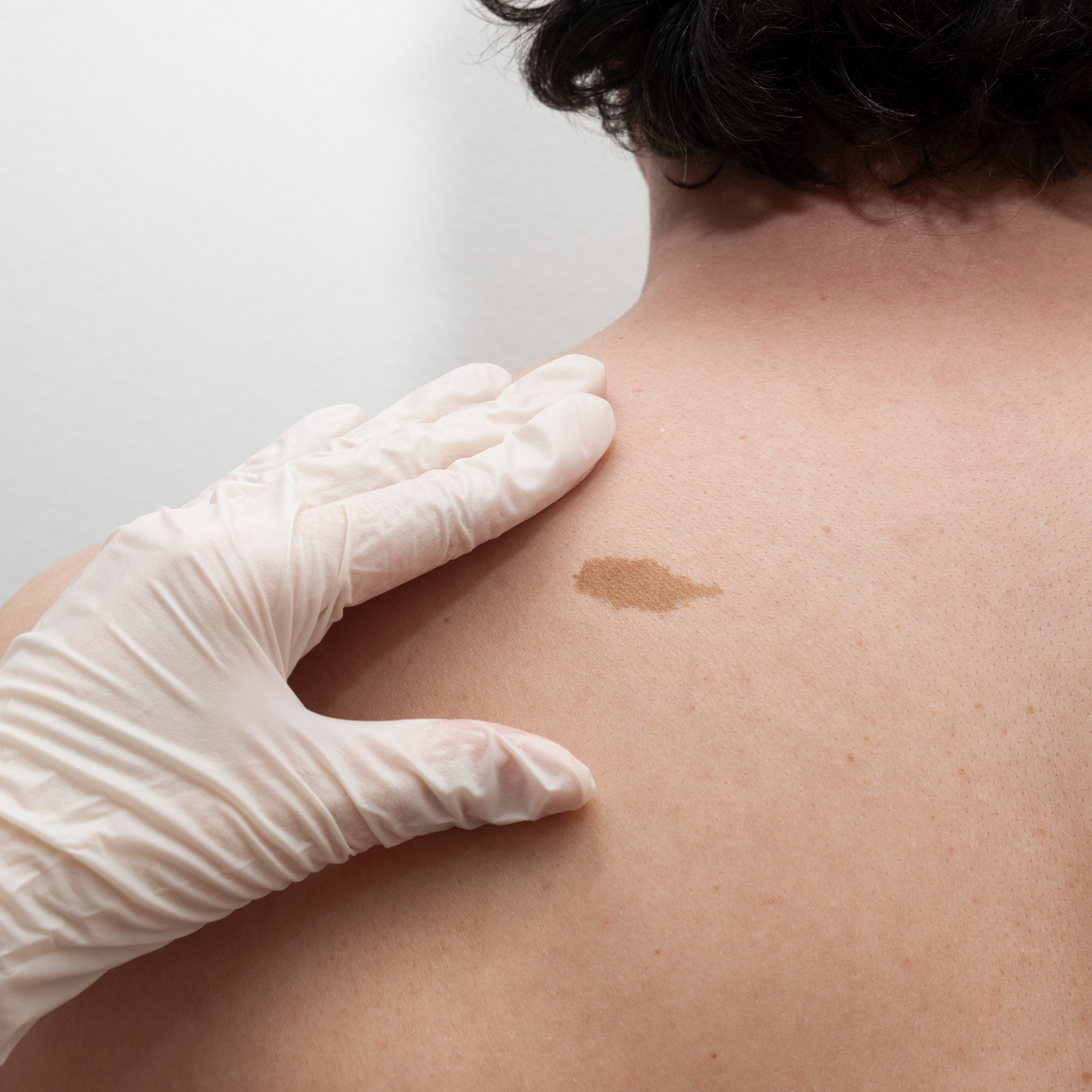 Znamiona pod kontrolą – wideodermatoskopia
